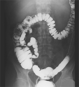 Radiografía del colon