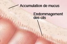 Cellules aux cils endommagés montrant une accumulation de mucus et des particules dans le mucus.