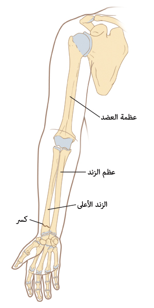 شكل توضيحي يظهر المخطط للذراع والعظام الموجودة فيه، بما في ذلك عظم العضد وعظم الزند، وكسر في الكعبرة (Radius).