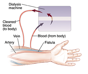 Arm showing fistula between vein and artery. Dialysis catheters inserted in vein move blood from body to dialyzer and back to body.