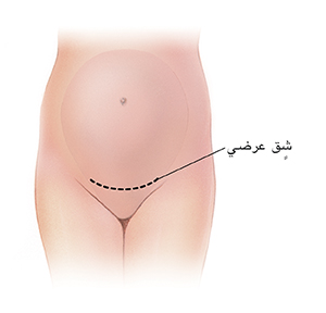صورة الشقّ العرضي