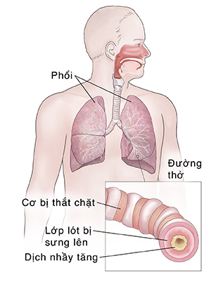 Mặt trước của người đàn ông cho thấy hệ hô hấp. Hình in cho thấy đường hô hấp bị viêm.