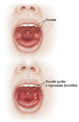 Vista frontale di un viso con la bocca aperta che mette a confronto la cavità orale e le tonsille normali con la gola infiammata e le tonsille ingrossate.