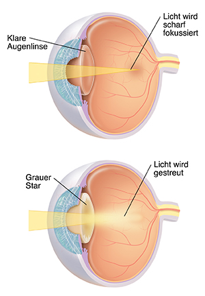 Dreiviertelansicht des Auges mit Augenlinse, die das Licht scharf fokussiert. Dreiviertelansicht des Auges mit Lichtstreuung durch Grauen Star.