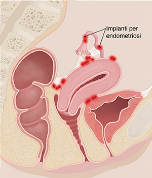 Vista laterale in sezione trasversale del bacino di una donna con aree infiammate di endometriosi in evidenza.