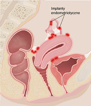 Widok przekroju miednicy kobiety od boku pokazujący stan zapalny wynikający z endometriozy.