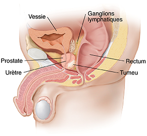 Vue latérale des organes pelviens d'un homme montrant une tumeur dans la prostate.