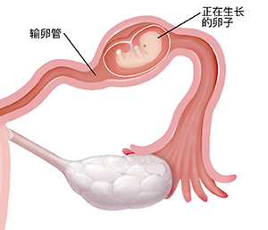 宫外孕中胚胎正在生长的输卵管横截面特写镜头。