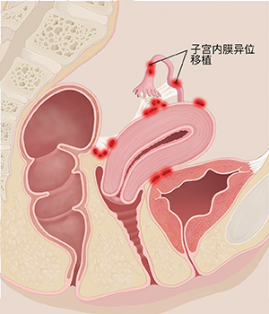 显示子宫内膜异位发炎部位的女性骨盆横截面侧视图。