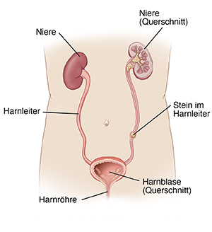 Darstellung der Harnwege mit Nieren, Harnblase, Harnröhre und einem Stein im Harnleiter.