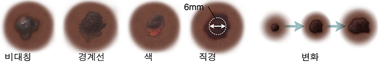 비대칭 형태의 점. 경계선이 불규칙적이고 흐릿한 점. 짙은 색과 밝은 색의 반점들로 이루어진 점. 직경 6mm의 점. 시간이 지나면서 달라지는 점 3개.
