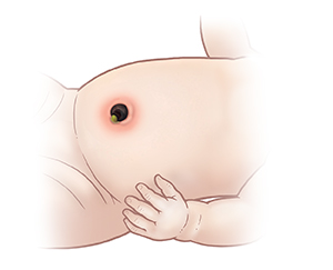 臍帯断端の周囲の腹部に炎症が見られる赤ちゃんの腹部の拡大図。