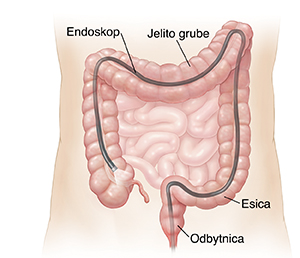 Zarys brzucha pokazujący endoskop umieszczony w jelicie grubym poprzez odbyt.