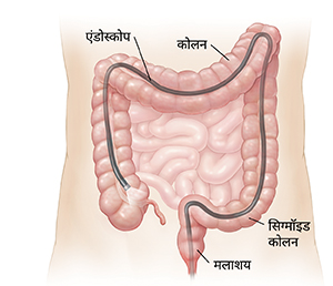 पूरे कोलन में गुदा के माध्यम से डाले गए स्कोप को दर्शाते हुए पेट की रूपरेखा।