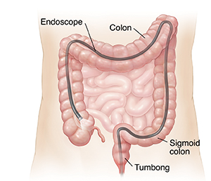 Balangkas ng tiyan na ipinakikita ang scope na nakapasok sa pamamagitan ng puwit hanggang sa buong colon.