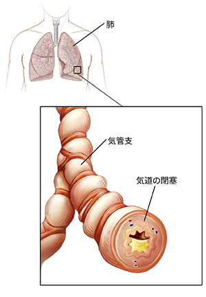 心臓と心膜を示す人の胸の略図。炎症と粘液の蓄積を示す気管支の拡大図。