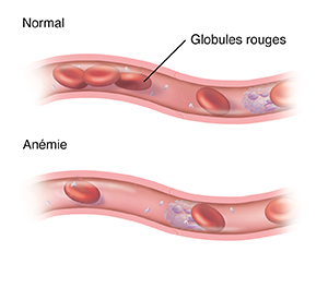 Coupe transversale d'un vaisseau sanguin contenant une quantité normale de globules rouges. En dessous se trouve une autre coupe transversale d'un vaisseau sanguin montrant une quantité insuffisante de globules rouges, causée par l'anémie.