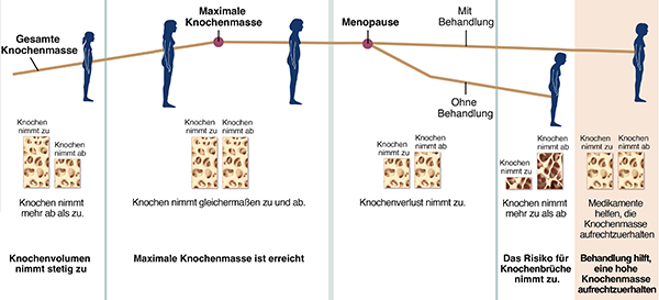 Grafik zur Veranschaulichung des Knochenwachstums und -verlusts im Verlauf des Lebens einer Frau, mit und ohne Behandlung der Osteoporose.