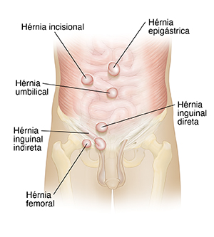 Vista frontal de um abdome masculino mostrando os tipos de hérnias.