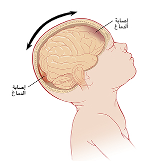 صورة جانبية لطفل رأسه تميل للخلف، تُظهر الدماغ من الداخل. تُظهر الأسهم رأسًا يتحرك إلى الخلف والأمام وإصابات في جانبي الدماغ الأمامي والخلفي.