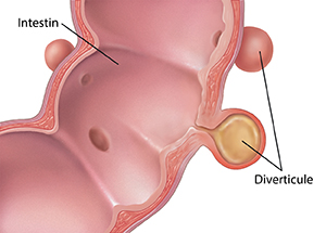 Coupe transversale d'un intestin montrant des diverticules dans la paroi intestinale.