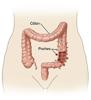 Silhouette de la partie inférieure du corps montrant le côlon et les poches de diverticulose.