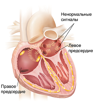 Поперечный срез сердца: показана фибрилляция предсердий.