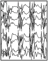 Tracciato EEG durante una crisi generalizzata.