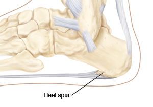 An outline of the foot showing bones in the foot, the plantar fascia, and a heel spur.