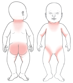 Outline of baby from back with shaded areas around neck and on buttocks and inner thighs. Outline of baby from front with shaded areas around neck, in armpits, and in groin.