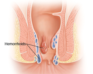 Cross section of rectum showing hemorrhoids.