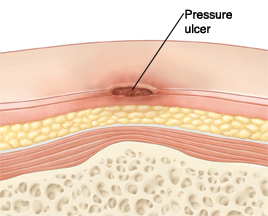 Pressure ulcer on the skin.