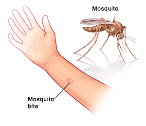 Mosquito, and a red, swollen bite on an arm caused by mosquito bite.