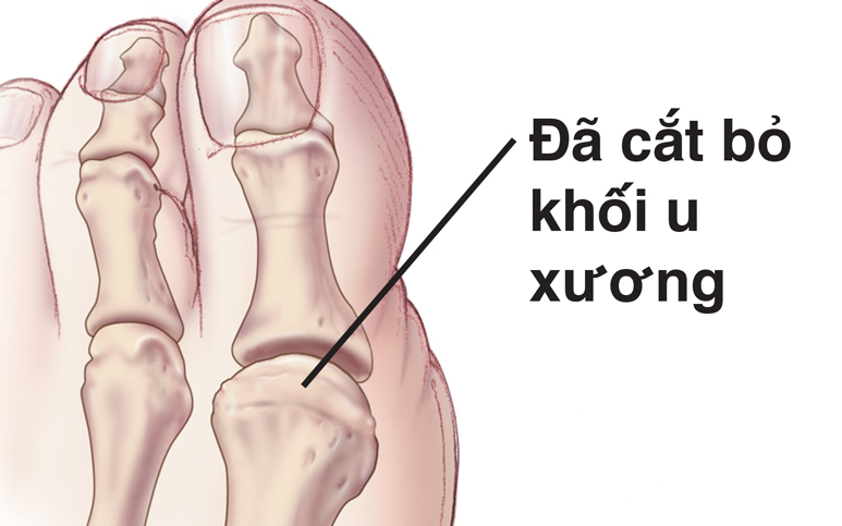 Tăng trưởng xương bị cắt cụt trong ngón chân cái