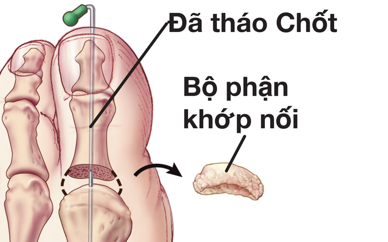 Khớp được tháo và trục ốc được thêm vào ngón chân cái