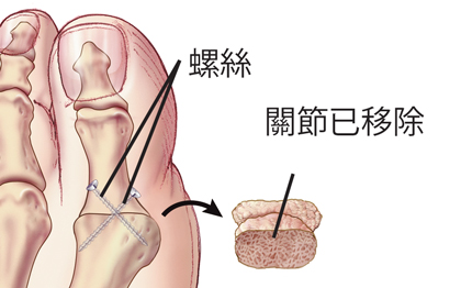 關節已移除,在大腳趾上安裝了螺絲