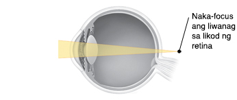 Cross section ng mata na ipinakikita ang liwanag na nagfo-focus sa likod ng retina.