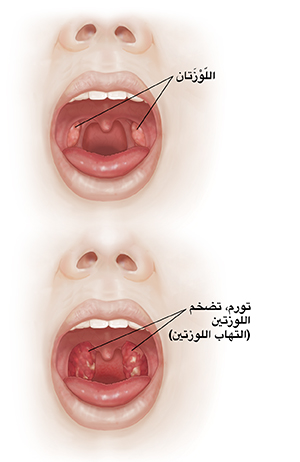 صورة أمامية لوجه شخص بفم مفتوح لمقارنة تجويف الفم واللوزتين مع التهاب الحلق وتضخم اللوزتين.