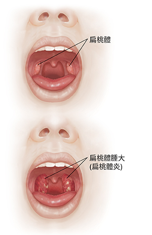 張開嘴的臉部正面圖,將口腔和扁桃腺與發炎的喉嚨和腫大的扁桃腺進行比較。
