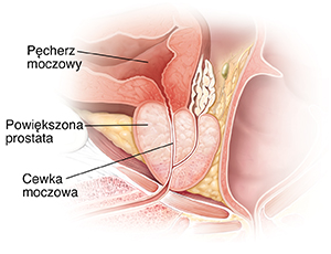 Przekrój powiększonego gruczołu prostaty.