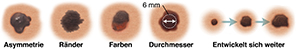 Muttermal mit asymmetrischer Form. Muttermal mit unebenen, verwaschenen Rändern. Muttermal mit dunklen und hellen Flecken. Muttermal mit einem Durchmesser von 6 mm. Drei Muttermale, die sich im Laufe der Zeit verändert haben.