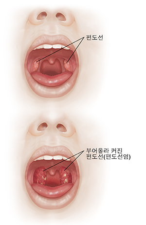 구강 및 편도선을 목구멍 염증 및 부어오른 편도선과 비교해서 보여주는 입을 벌린 얼굴의 정면 모습.