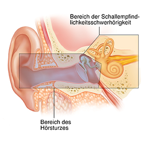 Querschnitt eines Ohrs mit den äußeren, inneren und mittleren Strukturen. Farbliche Überlagerung zeigt Bereiche, die einen Hörsturz und eine Schallempfindlichkeitsschwerhörigkeit verursachen.