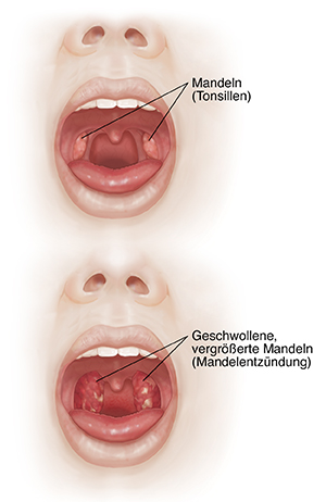 Vorderansicht eines geöffneten Munds zum Vergleich einer Mundhöhle mit normalen Mandeln (Tonsillen) und einem entzündetem Hals mit vergrößerten Mandeln.