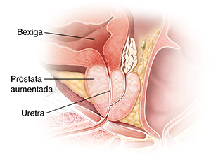 Seção transversal da glândula da próstata aumentada.