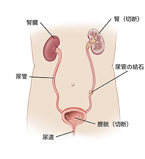 腎臓、膀胱、尿道、尿管内の結石など、泌尿器系の解剖学的構造を示す図。