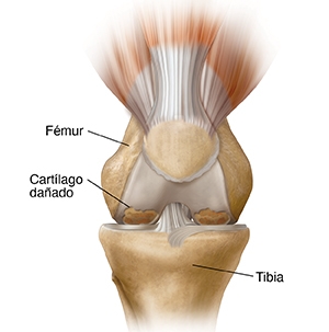 Vista frontal de una rodilla con osteoartritis.