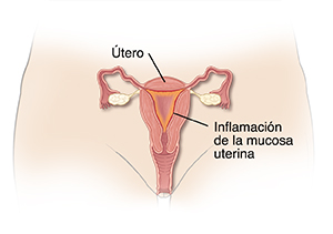 Vista frontal de un corte transversal de la vagina y del útero donde se observa el revestimiento del útero inflamado.