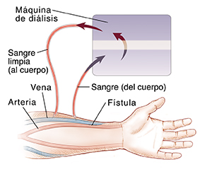 Brazo donde se observa una fístula entre la vena y la arteria. Catéteres de diálisis introducidos en una vena, que trasladan la sangre desde el cuerpo hasta el dializador, y de vuelta al cuerpo.