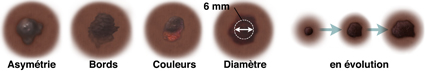 Un grain de beauté de forme asymétrique. Un grain de beauté avec un bord irrégulier et flou. Un grain de beauté avec des régions sombres et claires. Un grain de beauté d'un diamètre de 6 mm. Trois grains de beauté montrant des changements au fil du temps.